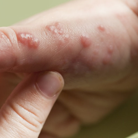 leczenie chorób dermatologicznych
